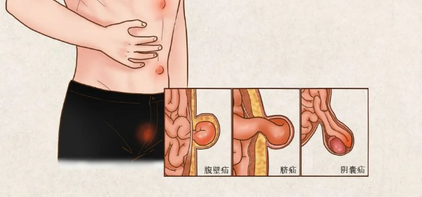 勿以“疝”小而不为 哈医大四院普